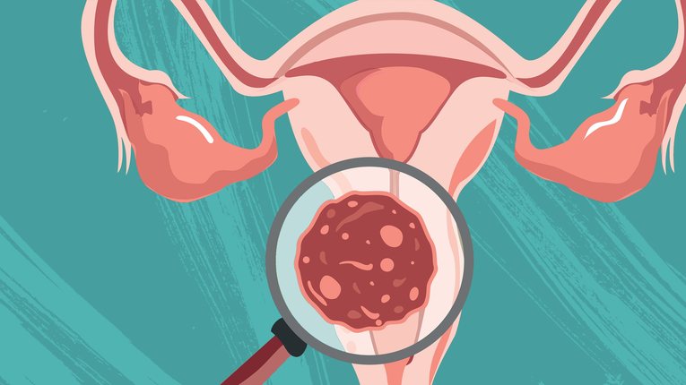Cerca de 3 mil mulheres japonas morrem todos os anos vítimas de câncer de colo do útero, doença prevenível com vacinação contra o HPV